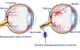 Тромбоз вен и артерий сетчатки глаза