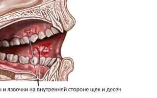 От чего появляются болезненные язвочки во рту: как выявить и избавиться от афтозного стоматита