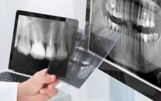 Ортопантомография зубных рядов: как делается и зачем нужен в стоматологии
