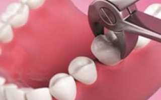 Технология и показания к удалению зубов: как подготовиться к процедуре и избежать осложнений