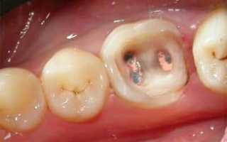 Что делать, если выпала пломба из зуба – как восстановить