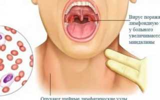 Симптомы стоматита в горле и как его лечить: эффективные препараты