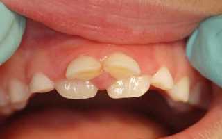 Сверхкомплектные зубы: причины возникновения и способы устранения гипердонтии