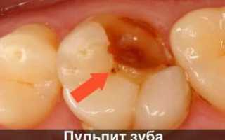 Как вылечить пульпит в зубе мудрости: симптоматика и особенности терапии