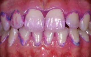 Образование зубного налета: причины и способы его удаления