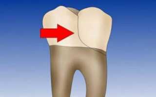 Трещина на зубе: что делать, если появилась вертикальная в эмали или раскрошился зуб на двое
