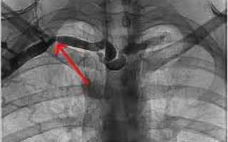 Синдром Педжета-Шреттера — причины тромбоза подключичной вены
