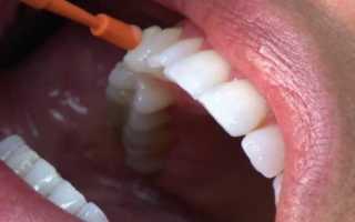 Как лечить кариес в стадии пятна в стоматологии и в домашних условиях