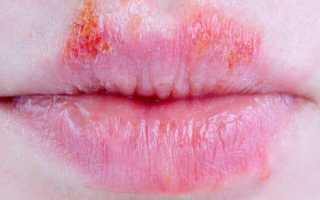 Формы, виды и особенности лечения хейлита на губах