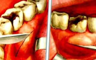 Надкостница зуба: почему воспаляется и болит и как ее лечить