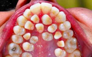 Аномалии развития зубов: формы и виды патологии