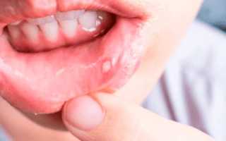 Чем лечить стоматит на губе и как быстро вылечить