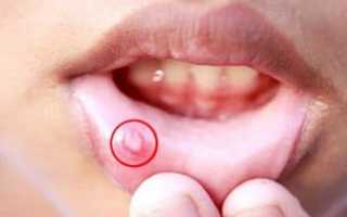 Стоматит и Мирамистин: как правильно применять при лечении язв во рту