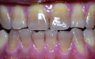 Гипоплазия зубной эмали у ребенка: как лечится патология