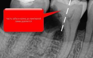 Как проводится гемисекция зуба: показания и возможные осложнения