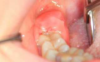Воспаление зуба мудрости и десны: что делать в домашних условиях