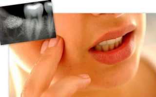 После лечения кариеса болит зуб при надкусывании: почему и что с этим делать
