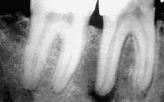 Особенности выявления и лечения периодонтита зубов: как избавиться от болезни