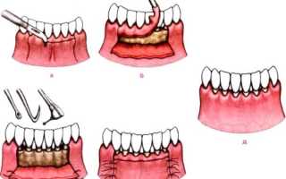Чем лечить пародонтоз в домашних условиях: зубы шатаются и выпадают – что делать