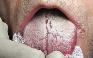 Грибковый стоматит: симптомы и лечение кандидоза полости рта