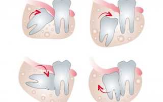 Почему зуб мудрости растет в зуб: особенности лечения дистопического моляра