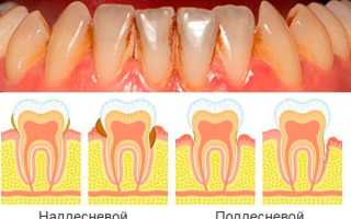 Что такое зубной камень и как можно от него избавиться