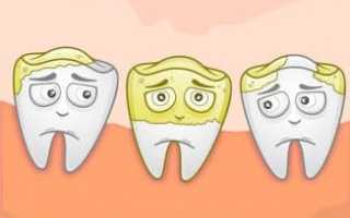 Поражение зубов кариесом: симптомы и признаки, как развивается и как лечится