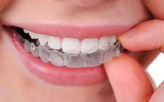 Признаки и способы устранения клиновидного дефекта зубов