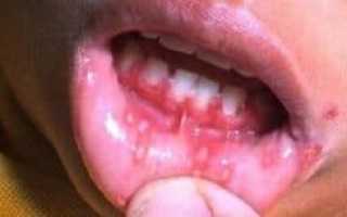 Как выявить и устранить герпес во рту: формы и особенности