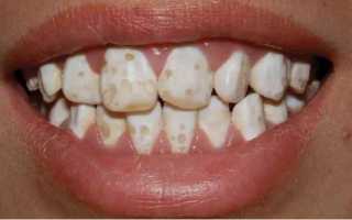 Белые точки на зубах: почему появляются на эмали у взрослого человека