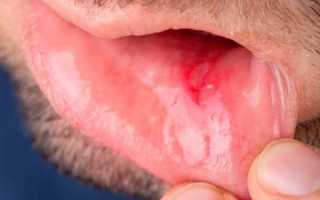 Воспаление во рту: как лечить воспалительный процесс на слизистой оболочке