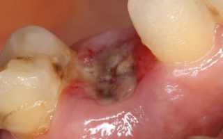 Что делать, если болит десна после удаления зуба: причины проблемы и дальнейшие действия
