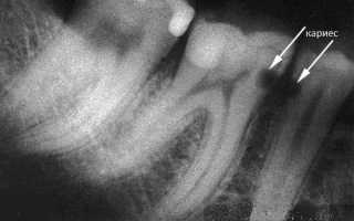 Кариес между зубов: как лечится в стоматологии и в домашних условиях