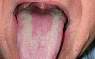 Особенности протекания и лечения кандидозного глоссита: как избавиться от грибка во рту
