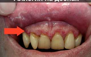 Красные точки на небе во рту: причины появления пятен на внетренней стороны губ, щек и языке