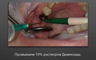 Альвеолит после удаления зуба: лечение и симптомы воспаления лунки