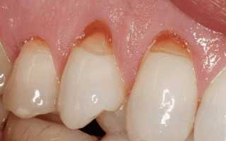 Почему болит зуб после пломбирования и что делать в домашних условиях