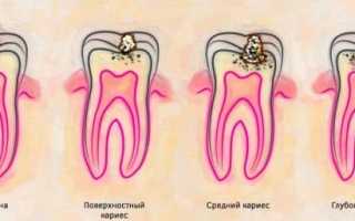 Лечение кариеса передних зубов: как выглядит и как лечат