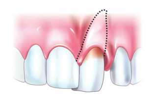 Разновидности о особенности устранения травм зубов и челюсти