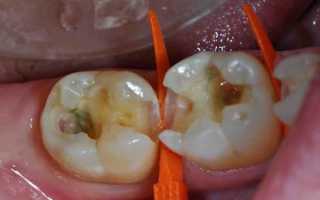Пульсирующая боль в зубе без нерва после лечения пульпита – почему и что делать