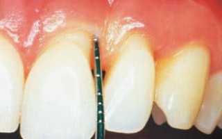 Оголение шейки зуба: почему это происходит и как лечить в домашних условиях