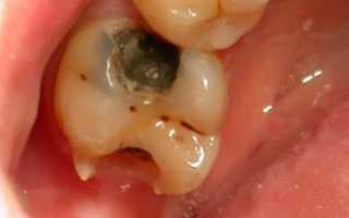 Все о причинах появления и методах лечения кариеса зуба мудрости
