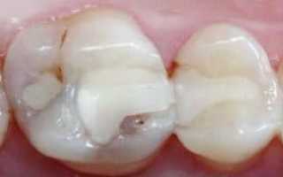 Как распознать и устранить вторичный кариес зубов: симптоматика и технология лечения