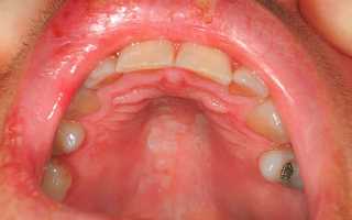 Герпес на слизистой рта: как лечить герпетические высыпания на слизистой ротовой полости