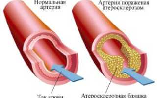 Атеросклероз брюшной аорты: симптомы и лечение