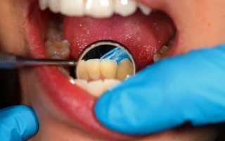 Методы диагностики кариеса: как определяется болезнь у стоматолога