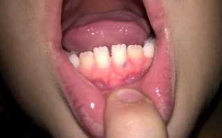 Болит десна около зуба: почему больно при надавливании на корень и как лечить боль