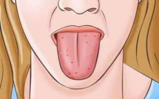 Болезни полости рта: основные инфекции во рту у человека