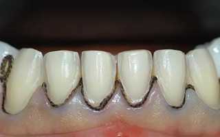 Можно ли вылечить кариес корня зуба и как лечат корневой
