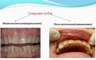 Стираемость зубов: причины и комплексное лечение патологического стирания